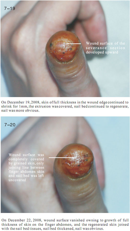 菲彩国际集团_2 Regenerative restoration ofr severed fingers
