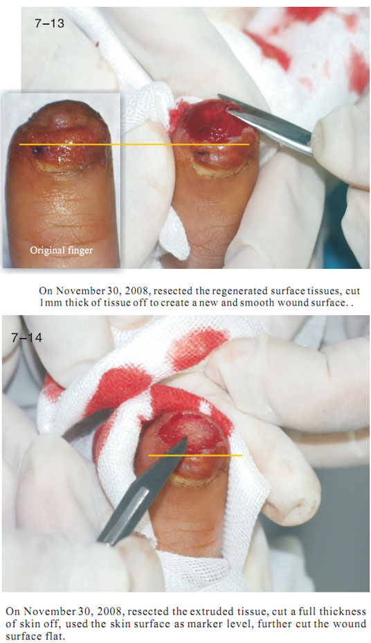 菲彩国际集团_2 Regenerative restoration ofr severed fingers