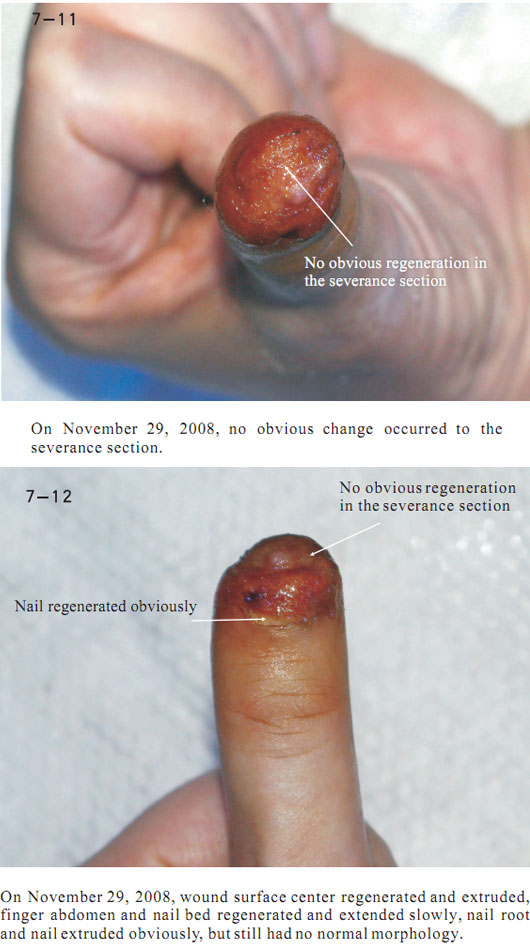 菲彩国际集团_2 Regenerative restoration ofr severed fingers