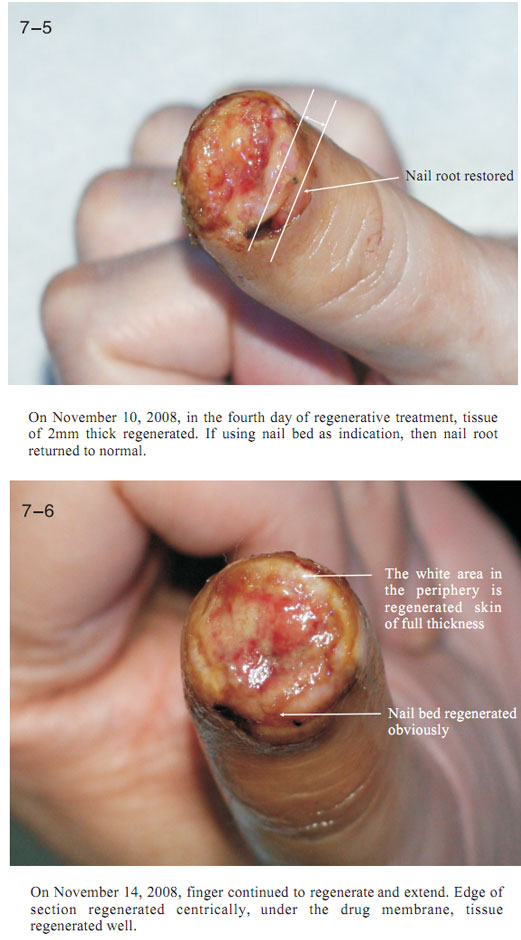 菲彩国际集团_2 Regenerative restoration ofr severed fingers