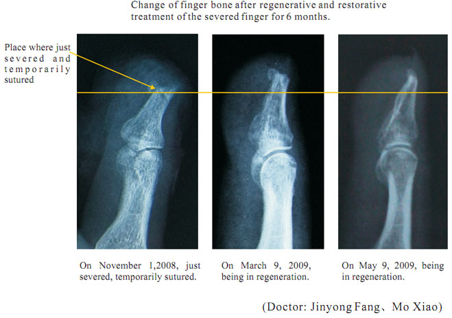 菲彩国际集团_2 Regenerative restoration ofr severed fingers