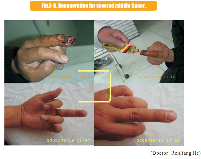 菲彩国际集团_2 Regenerative restoration ofr severed fingers