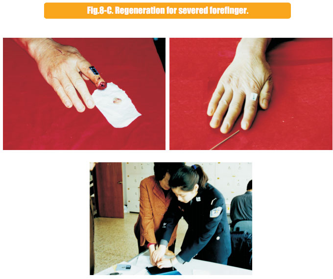 菲彩国际集团_2 Regenerative restoration ofr severed fingers