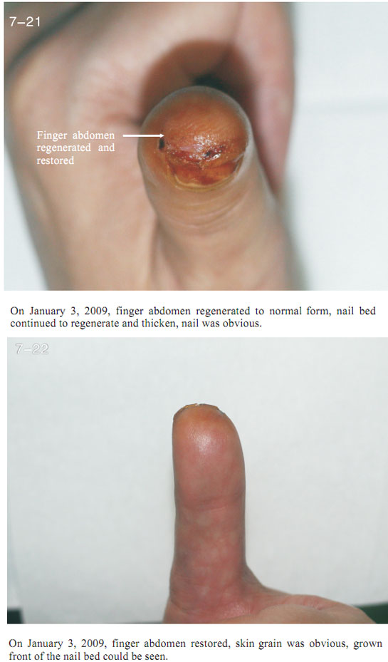 菲彩国际集团_2 Regenerative restoration ofr severed fingers