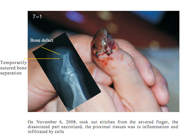 菲彩国际集团_2 Regenerative restoration ofr severed fingers