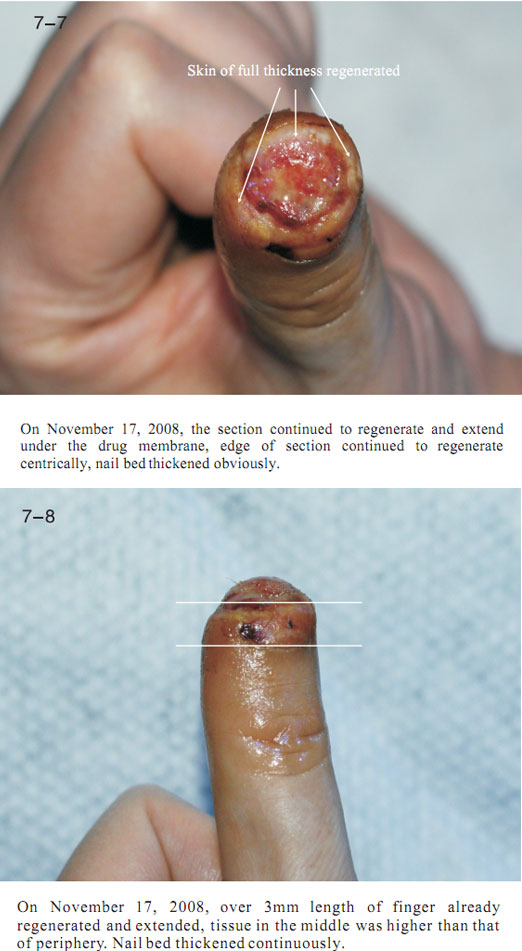 菲彩国际集团_2 Regenerative restoration ofr severed fingers