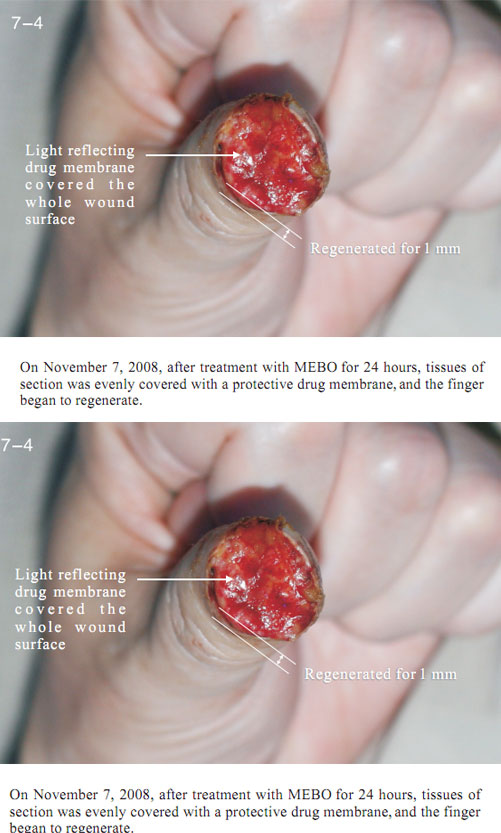 菲彩国际集团_2 Regenerative restoration ofr severed fingers
