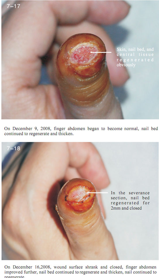 菲彩国际集团_2 Regenerative restoration ofr severed fingers