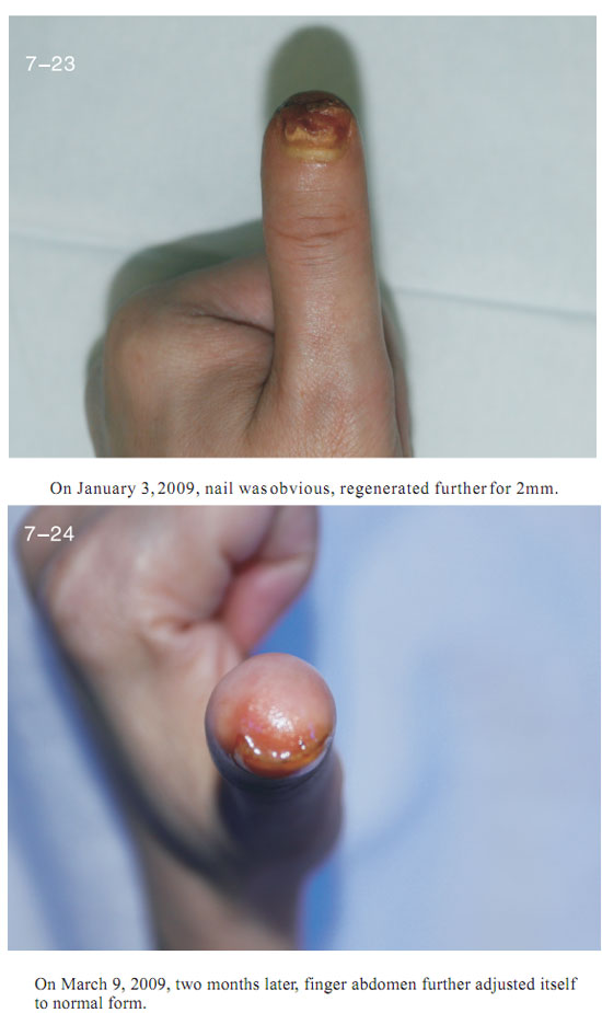 菲彩国际集团_2 Regenerative restoration ofr severed fingers