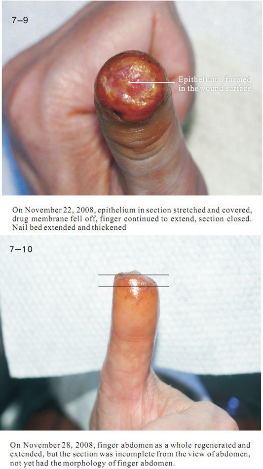 菲彩国际集团_2 Regenerative restoration ofr severed fingers