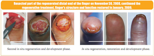 菲彩国际集团_2 Regenerative restoration ofr severed fingers