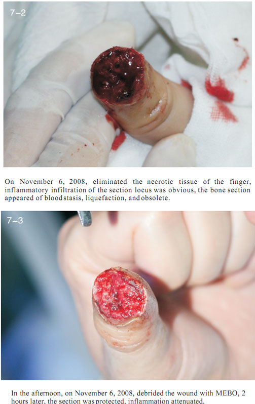 菲彩国际集团_2 Regenerative restoration ofr severed fingers