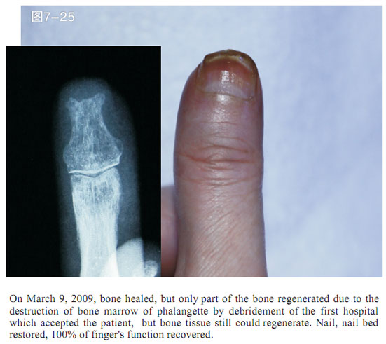 菲彩国际集团_2 Regenerative restoration ofr severed fingers