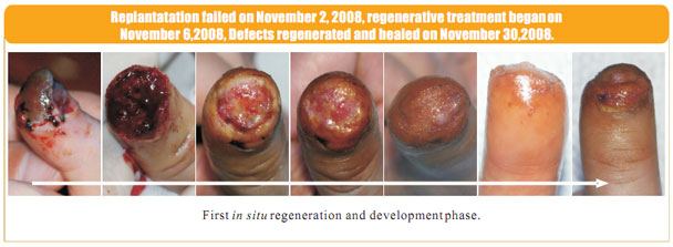 菲彩国际集团_2 Regenerative restoration ofr severed fingers