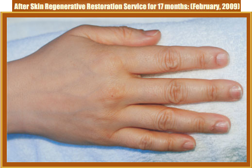 菲彩国际集团_Part Two: Examples of in situ Skin Regenerative Restoration