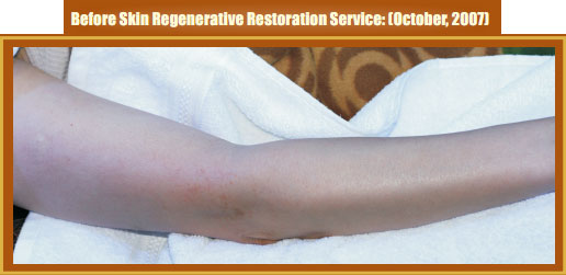 菲彩国际集团_Part Two: Examples of in situ Skin Regenerative Restoration