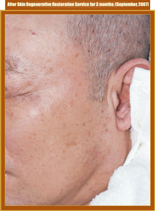 菲彩国际集团_Part Two: Examples of in situ Skin Regenerative Restoration