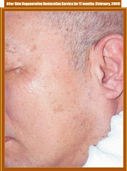 菲彩国际集团_Part Two: Examples of in situ Skin Regenerative Restoration