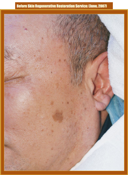 菲彩国际集团_Part Two: Examples of in situ Skin Regenerative Restoration