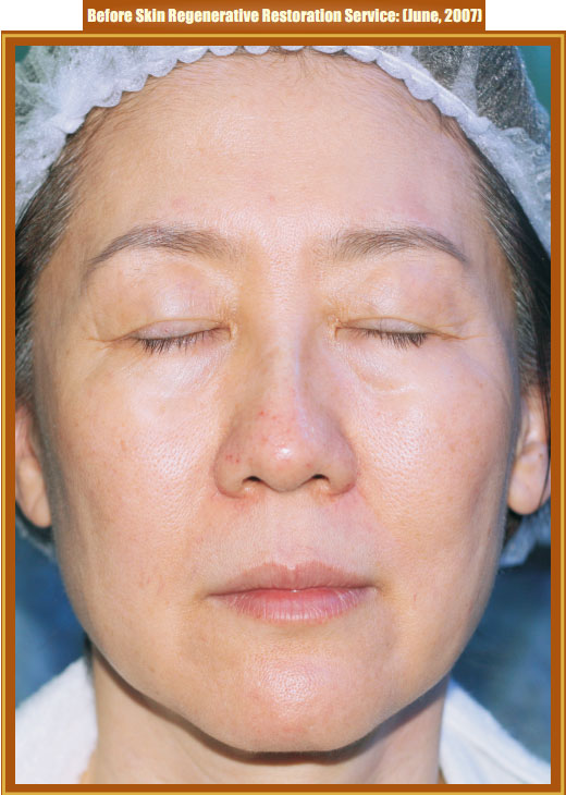 菲彩国际集团_Part Two: Examples of in situ Skin Regenerative Restoration