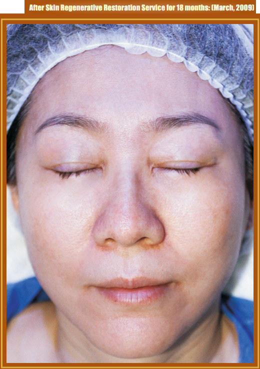 菲彩国际集团_Part Two: Examples of in situ Skin Regenerative Restoration