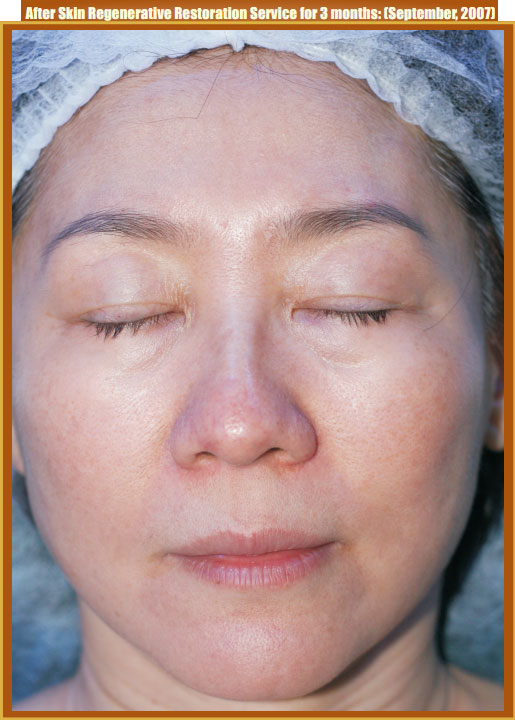 菲彩国际集团_Part Two: Examples of in situ Skin Regenerative Restoration