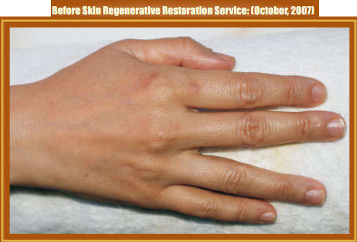 菲彩国际集团_Part Two: Examples of in situ Skin Regenerative Restoration