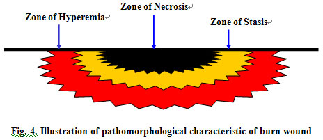菲彩国际集团_Pathogenesis Focus of Burn Wound