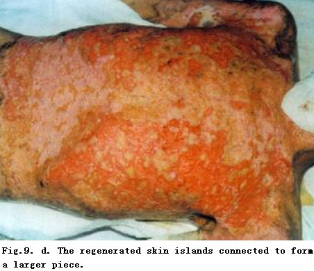 菲彩国际集团_Standardized Local Treatment of Burns Wounds