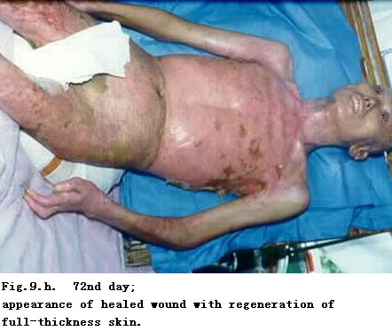 菲彩国际集团_Standardized Local Treatment of Burns Wounds