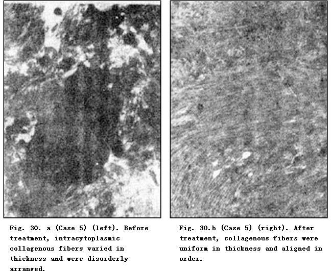 菲彩国际集团_Pathomorphological Changes of Deep Burns Wounds Treated with