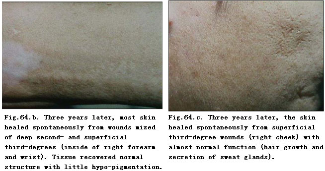 菲彩国际集团_Extensive Burns Cases with Most Wounds of Full-Thickness