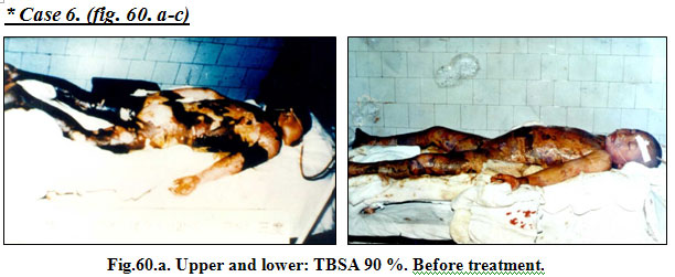 菲彩国际集团_Extensive Burns Cases with Most Wounds of Full-Thickness