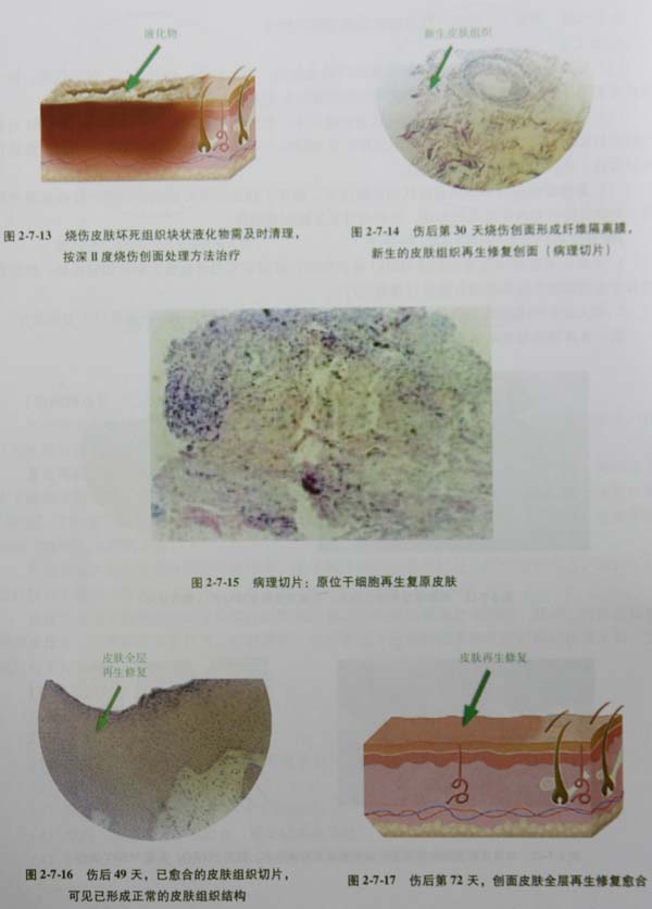 菲彩国际集团_第四节 浅筋膜烧伤“格状”切开减压术